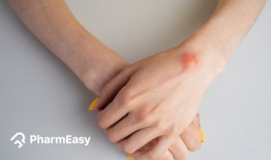 how to get rid of lipomas naturally