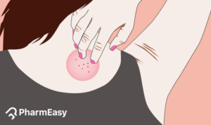 home remedies for ringworm