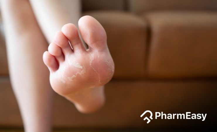 why do my feet sweat so much