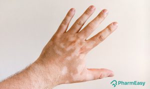 white patches on skin