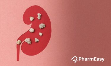 home remedies for kidney stones